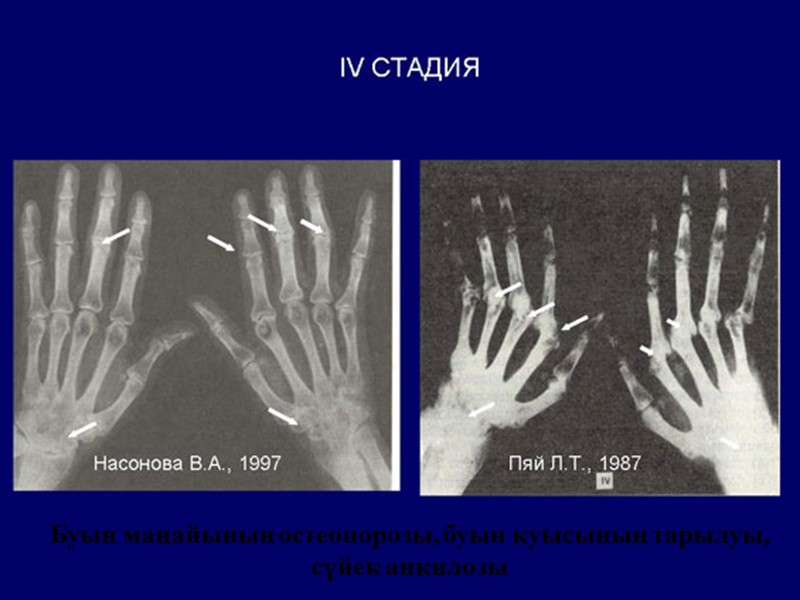 Буын маңайының остеопорозы, буын қуысының тарылуы, сүйек анкилозы